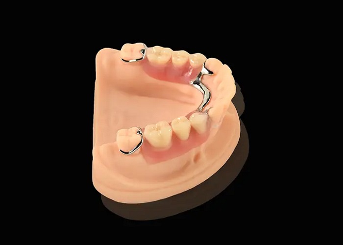 Upper Metal Partial Denture: A Strong Choice for Modern Dental Restoration