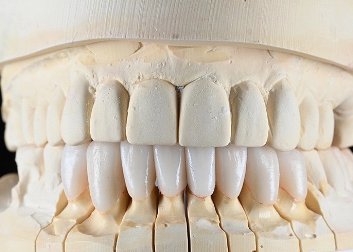Why Porcelain EMAX Veneers Are the Optimal Choice for Teeth Whitening?