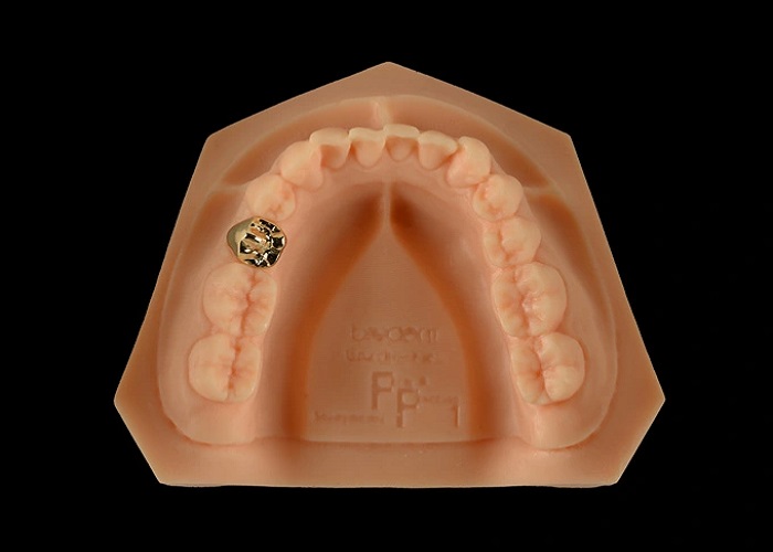 A Gold Partial Crown Adds Lasting Sparkle to Your Smile