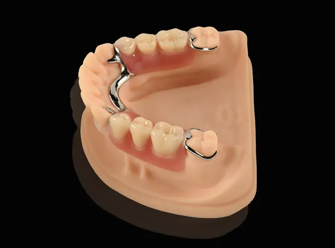 cast frame partial denture
