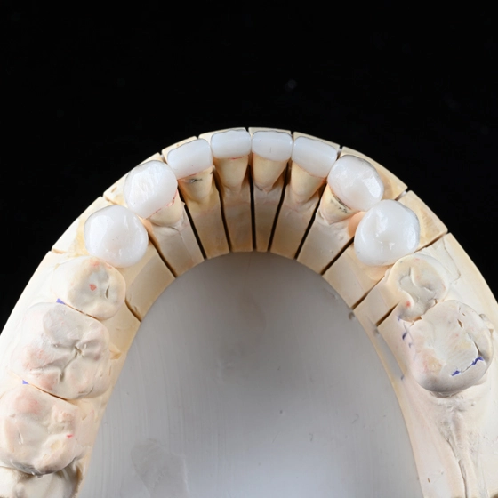 E.max Veneer