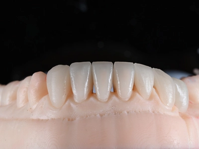 Full E.max Crown