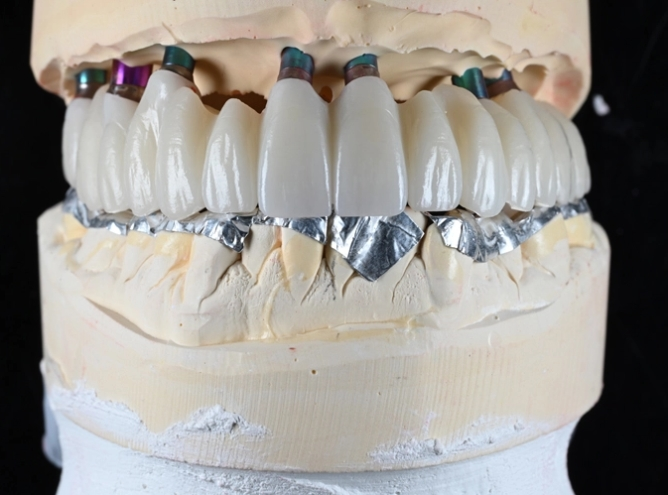 What is Zirconia Fixed Bridge?